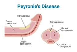 peyronies disease